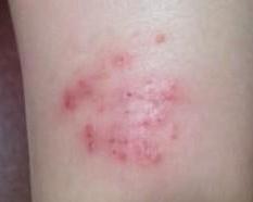 身上突然出现红疹子是什么原因引起的症状？