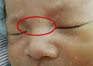 1.3 鼻梁青筋的双重特征