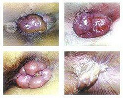一、 医学视角下的痣：定义、发病机制及临床特征