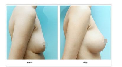 乳房下垂者的运势分析