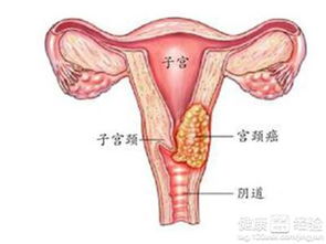 2. 早期宫颈癌或癌前病变