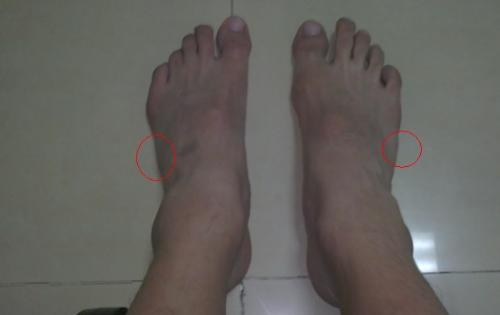 脚趾根部及脚底缘侧