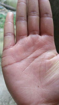 （五）手掌及手背之痣