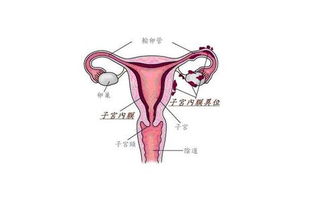 3. 子宫肌瘤：