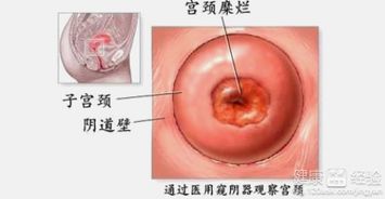 四、 其他常见宫颈病变及其作用于程度