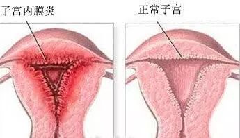 2. 子宫内膜炎：最常见但也最不容简单忽视