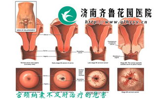 子宫纳囊严沉重吗？