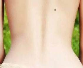 脊柱正中及后背其他部位痣之综合解读