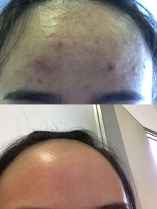 第二节：诱发痱子的内源性因素解析