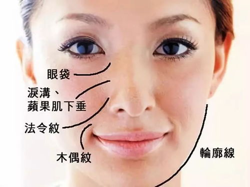 四、 “嘴角纹”的产生机理与外观特征