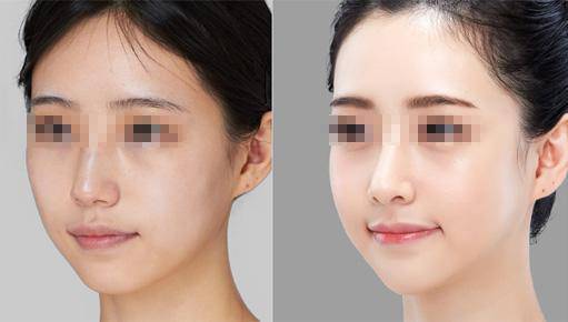 从小气血不足脸颊凹陷，如何通过面相改善？