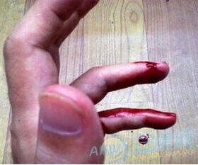 梦见亲人受伤流血是什么预兆或含义？