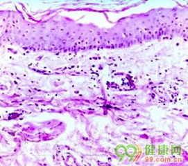 1. 肛周湿疹：一种常见的非传染性皮肤疾病