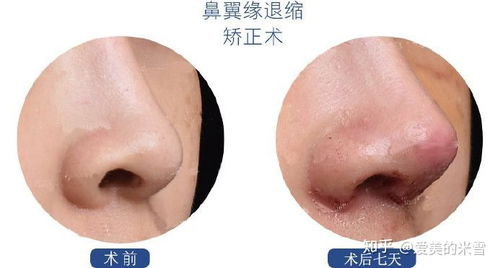 只缩鼻翼对风水有何具体影响？