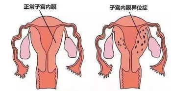 4. 子宫内膜异位症：