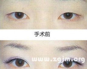 双眼皮：热情奔放与社交天赋的体现