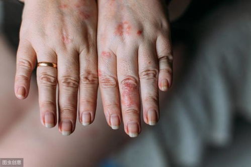 一、 饮食记录与过敏原追踪的必要性