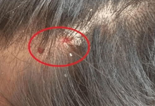 女人梦见头上长脓包头发掉是什么预兆？