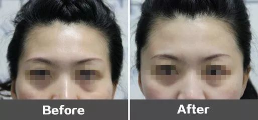 2、人中模糊：豪门最忌讳的面相