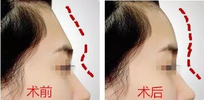 1. 注射填充材料的优势与局限