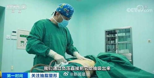 关于抽脂对生较小孩的作用于