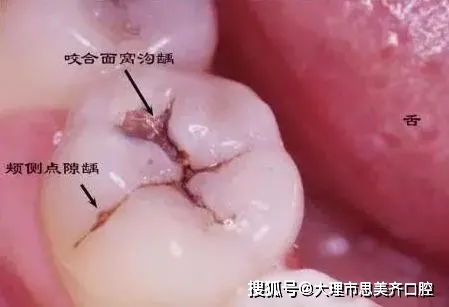 梦见蛀牙掉落预示着什么吉凶？