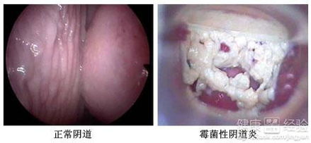 病症信号：阴道炎、 宫颈炎等妇科病症