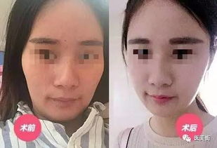 三、 凹陷鼻梁的具体形态学划分与生理状况特征解析
