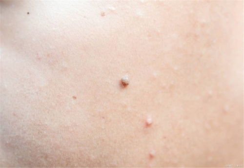 （二）面颊无肉区之恶痣