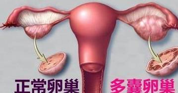 更多囊卵巢综合征：一个繁杂的病症