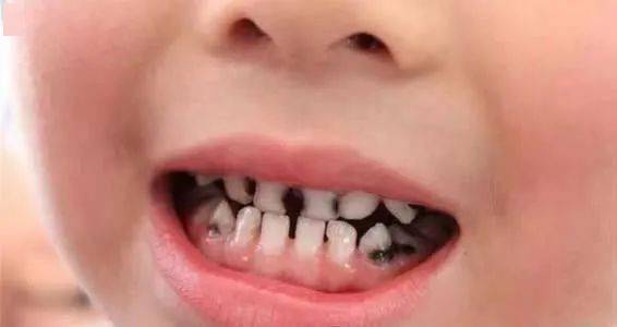 梦见自己的牙齿坏了是什么预兆或象征？