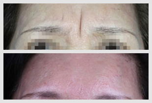 眉间纹和川字纹的风水影响有哪些？