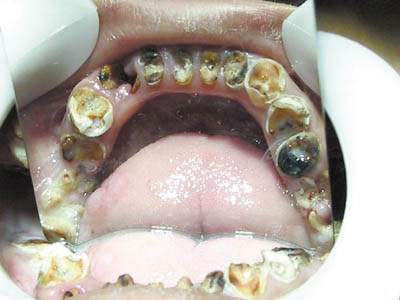 男人梦到牙齿松动预示着什么是不是意味着事业会发达？