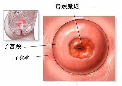 医治宫颈糜烂的方法：更多种选择