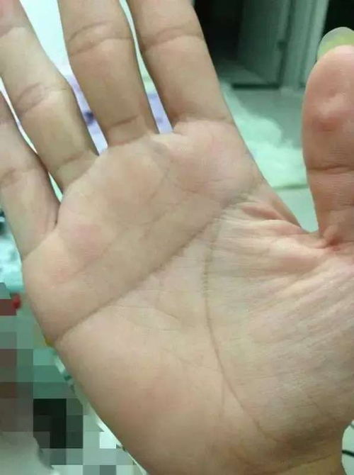男人手纹中断线，这预示着怎样的命运转折？