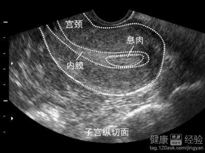3. 子宫内膜息肉：不规则出血的较小凶手