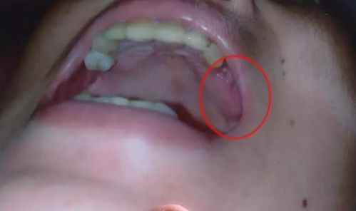 拔光牙齿镶金牙的女人命运如何？吉凶如何？