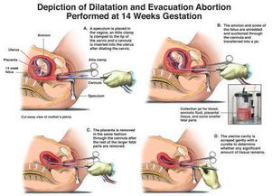 堕胎被视作“杀害亲人”的文化误读