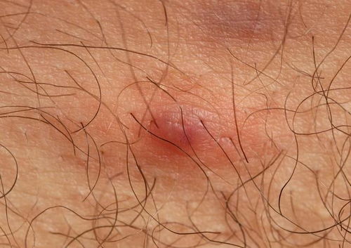 2. 肛门边痣的传统寓意