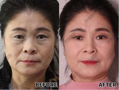 男人面相眼袋看寿命准吗？有没有治疗眼袋的最佳方法？