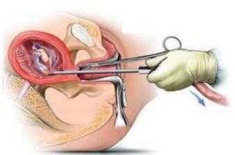 女人梦见自己流产预示着什么不祥的兆头？