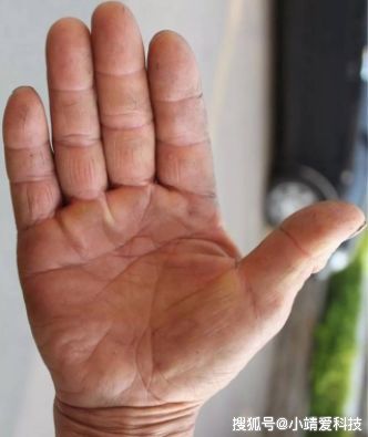 老年人脚底长老茧如何彻底去除？