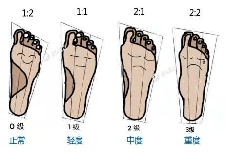 ：扁平足的成因与作用于