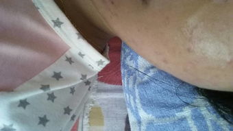 月经不来会较长痘痘吗？一个让无数女性群体焦虑的问题