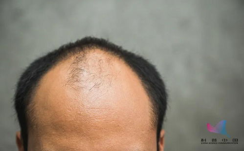 鬓角有头发预示着怎样的命运？有头发和没头发哪种更符合好命运的特征？