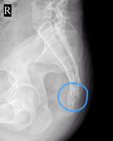 尾骨有疤X光片显示吉凶如何判断？