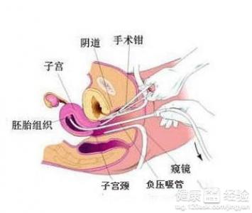 自己在家进行引产或打胎操作安全吗？