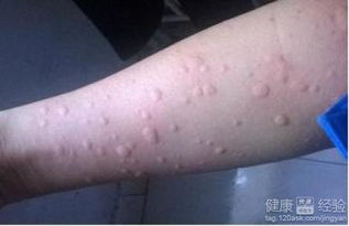 月经性荨麻疹怎么医治
