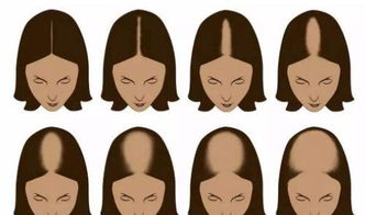 梦见女人秃顶是什么征兆？预示着什么不好的事情会发生吗？