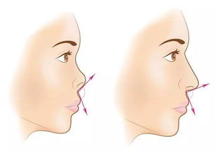 女版朝天鼻：婚姻杀手？